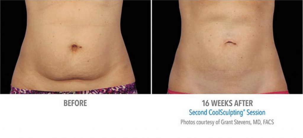 Before and after view of a stomach after CoolSculpting.