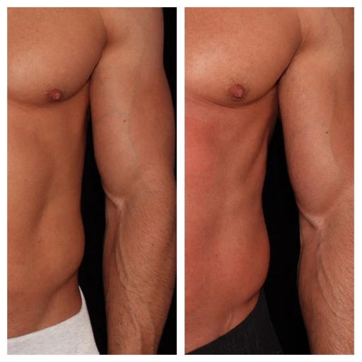 before-after-1