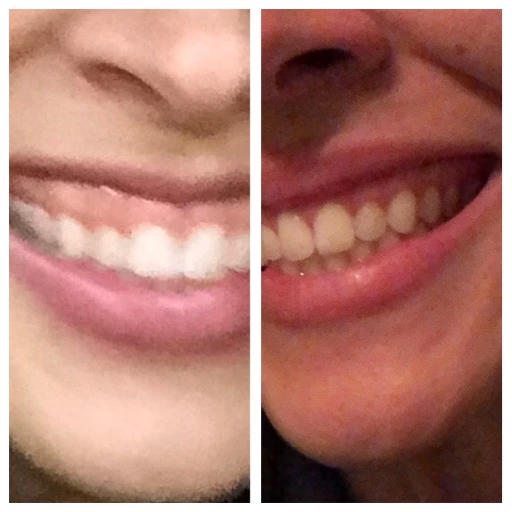 before-after-12