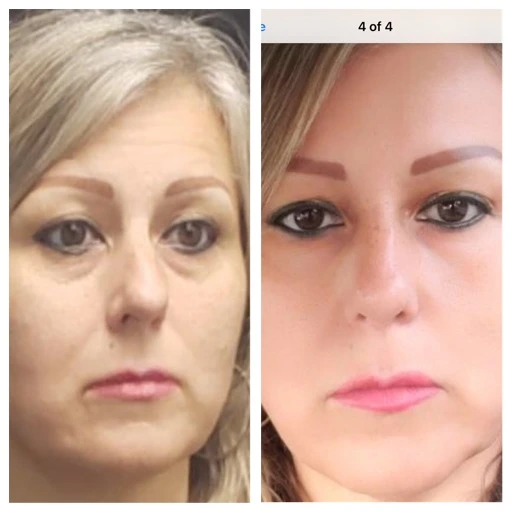 before-after-7
