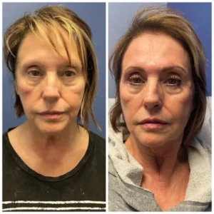before-after-15.webp