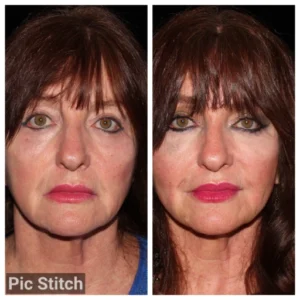before-after-4.webp