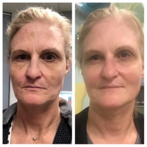 before-after-5.webp
