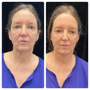 before-after-6.webp