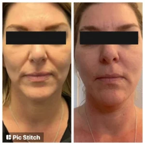before-after-14