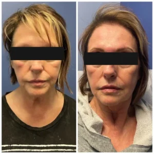 before-after-15