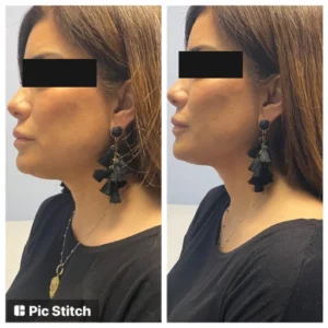 before-after-16