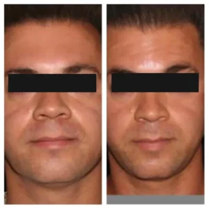before-after-19