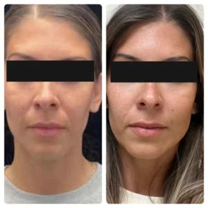 before-after-22