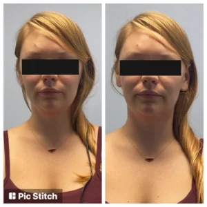 before-after-23