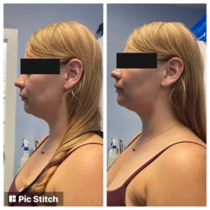 before-after-24