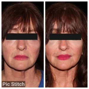 before-after-4