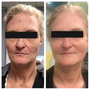 before-after-5