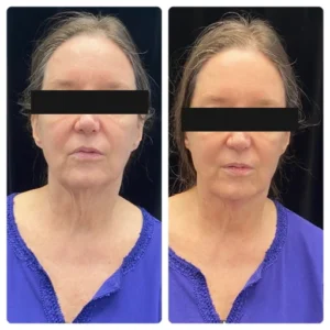 before-after-6