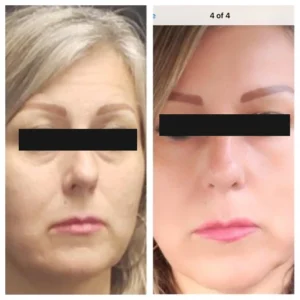 before-after-7