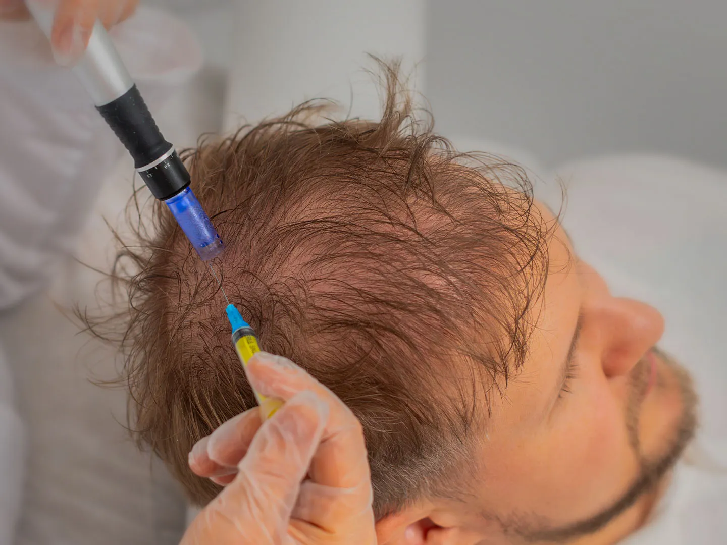 The Future of Hair Restoration: How Exosome Therapy Wakes Up Dormant Follicles
